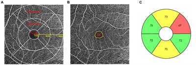 Early changes of ganglion cell-inner plexiform layer thickness and macular microvasculature in Posner-Schlossman syndrome: a binocular control study by OCTA